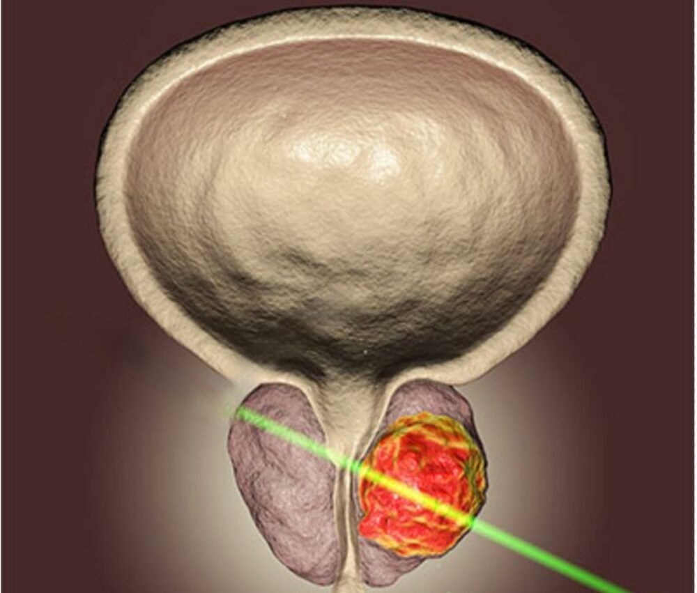 Cirurgia Holep em Manaus: com especialista e atendimento exclusivo